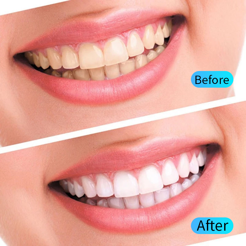 Zahnaufhellungsgel-Set, Mundhy – Teeth Whitening Opalescence Bewertung und Preis