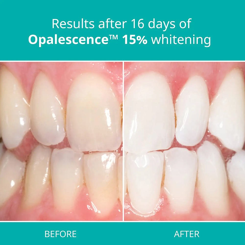 Opalescence Professional White – Teeth Whitening Opalescence Bewertung und Preis