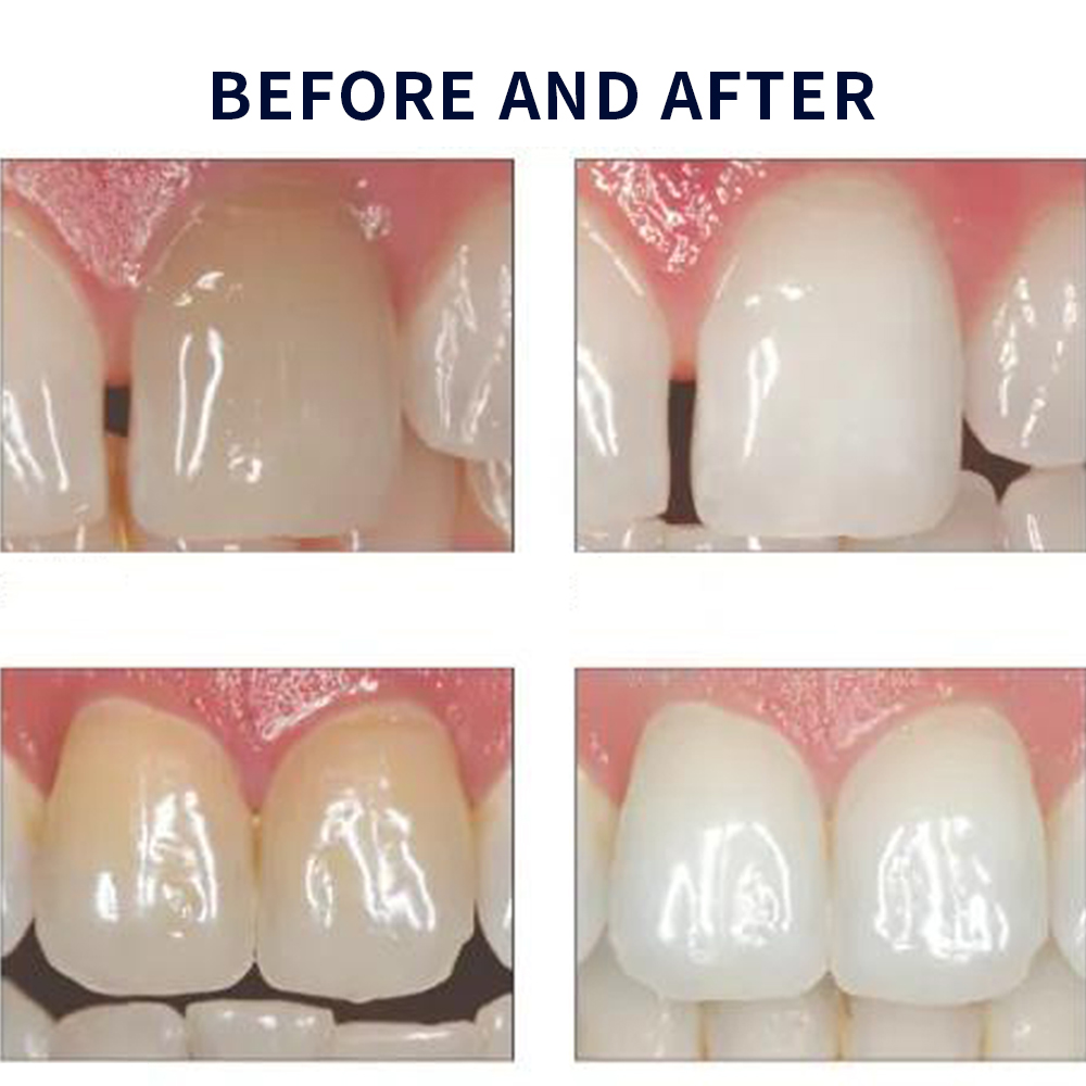 Opale scence White ning 1,2 pf – Teeth Whitening Opalescence Bewertung und Preis