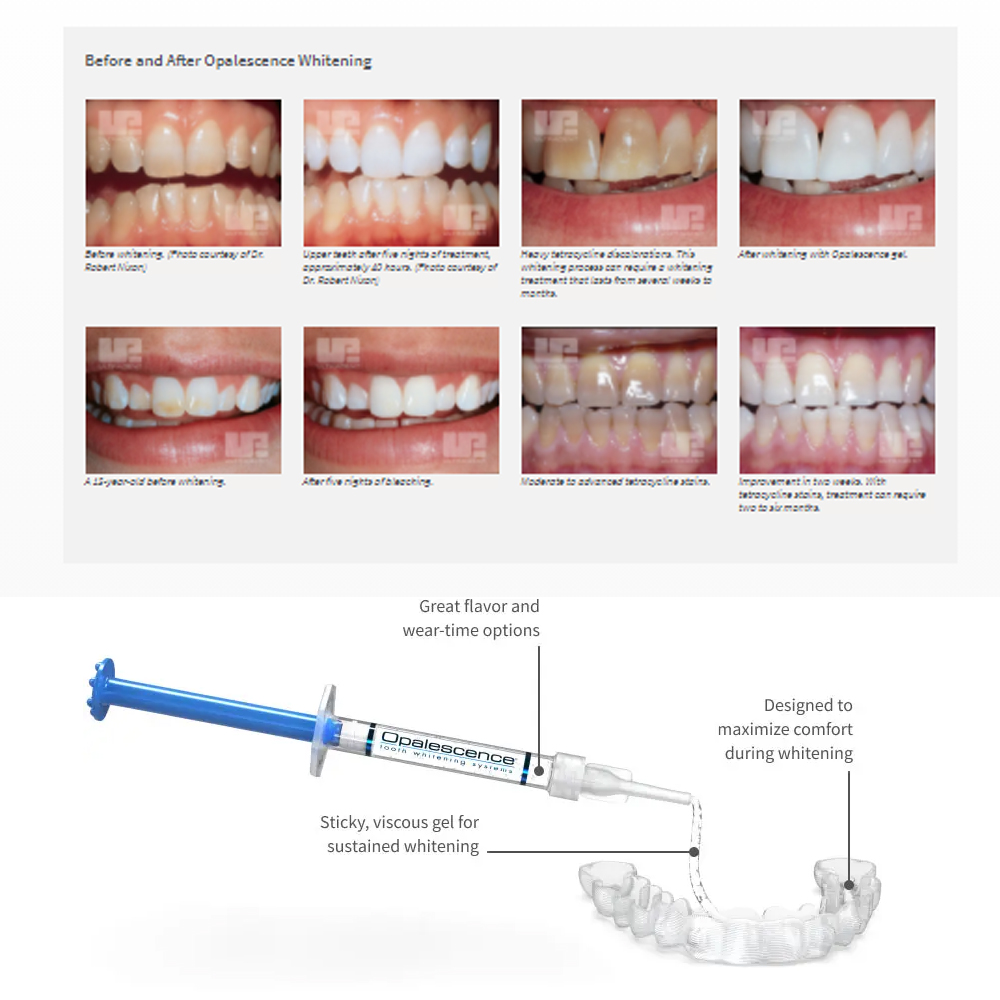 Opale scence White ning 1,2 pf – Teeth Whitening Opalescence Bewertung und Preis
