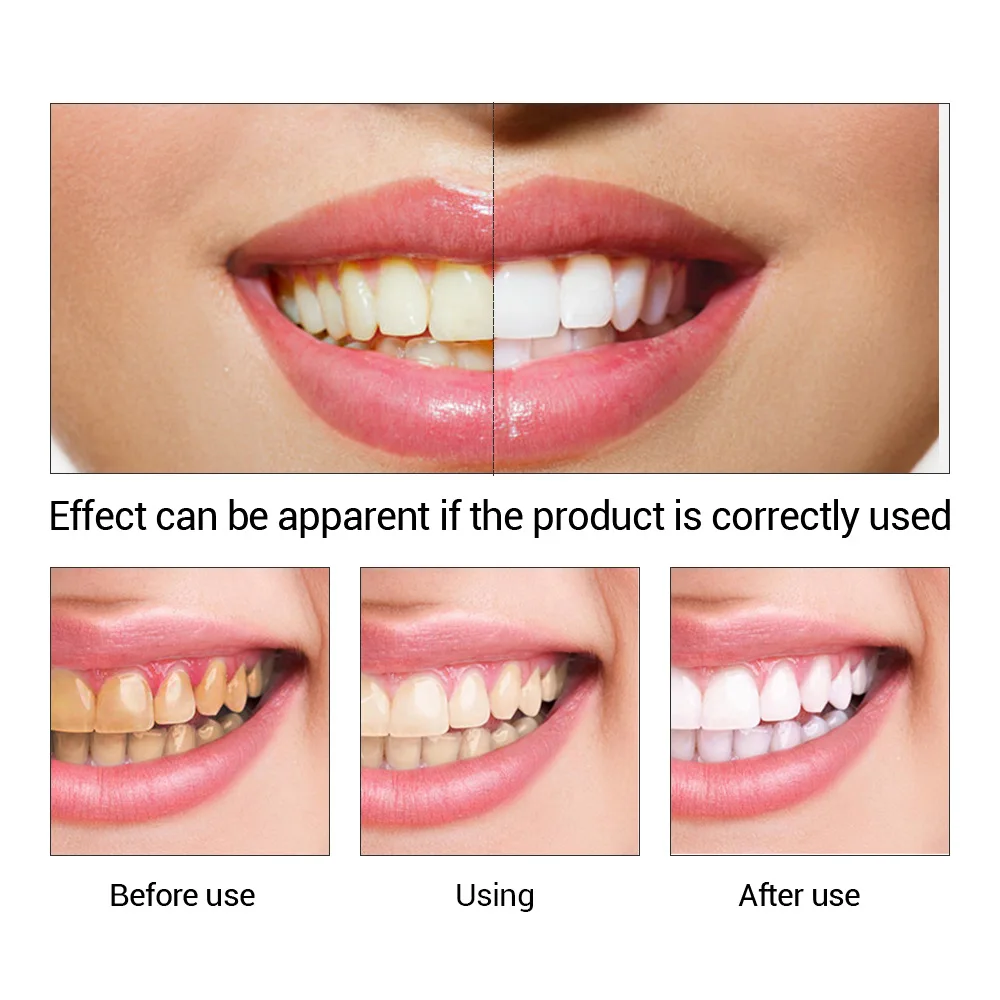 FTEENPLY Zahnaufhellung Essenz – Teeth Whitening Q&M Bewertung und Preis
