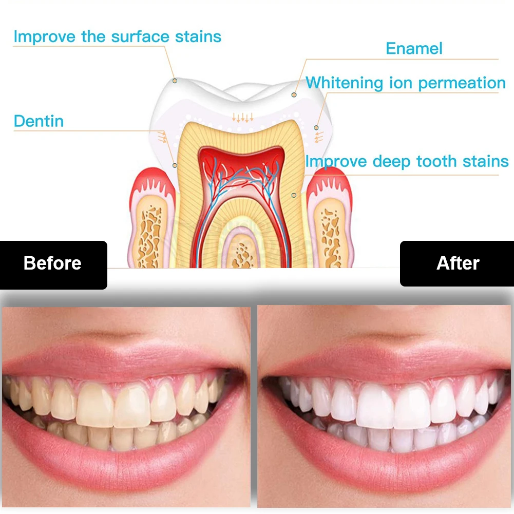 Dental Zahnaufhellung Kit Mini – Teeth Whitening Q&M Bewertung und Preis