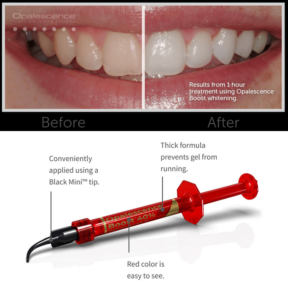 Ultradent Opalescence Boost PF – Teeth Whitening Opalescence Bewertung und Preis